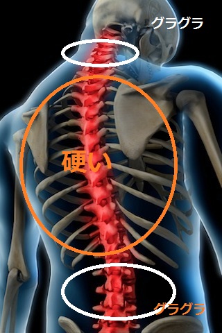 腰痛の原因を絵にするとこんな感じですの画像