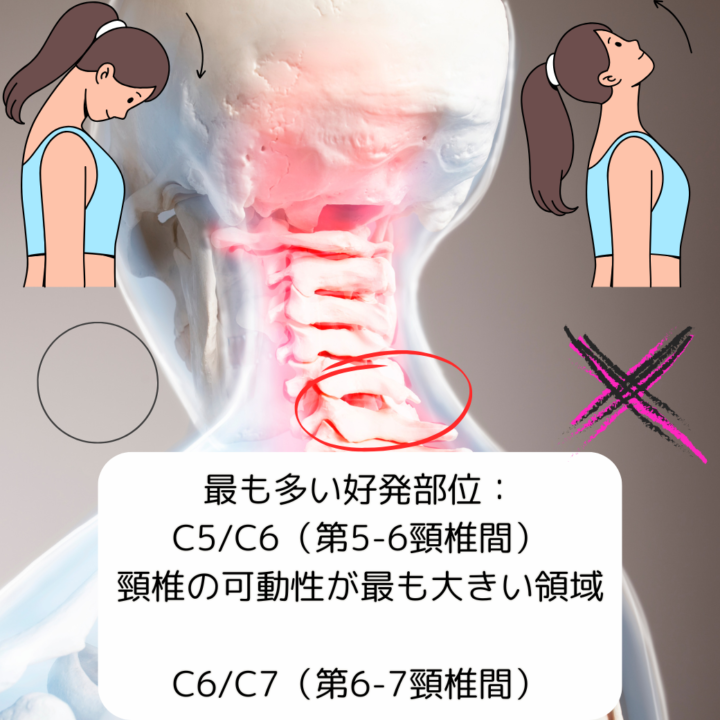 頸椎の伸展で神経を圧迫しているヨガやストレッチで注意