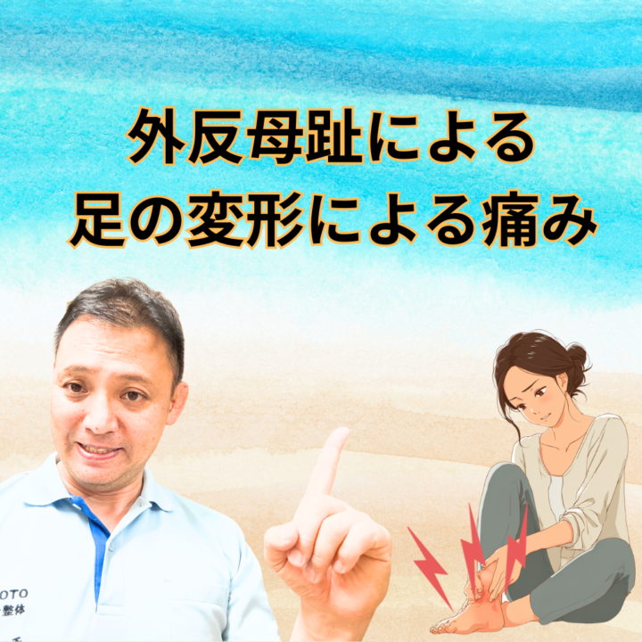 外反母趾による足の変形による痛みの画像
